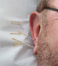 Akupunktúra ucha