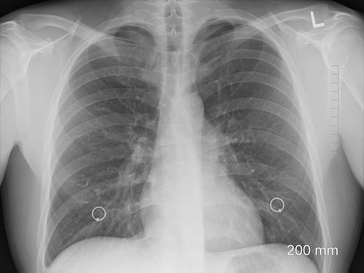 Snímok pľúc