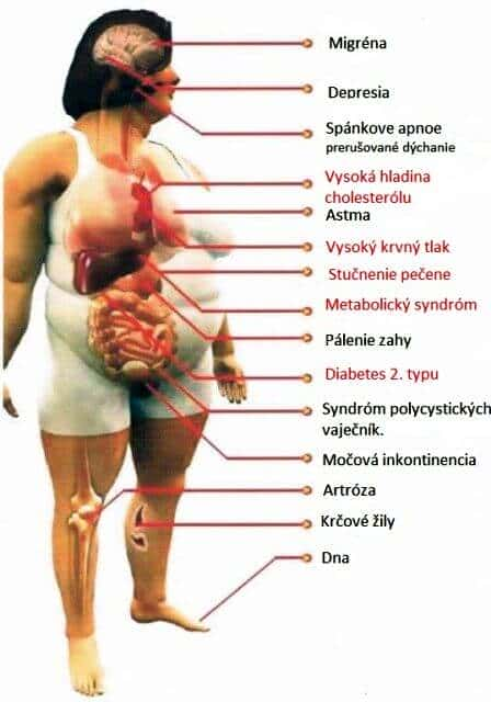Obezita - choroby