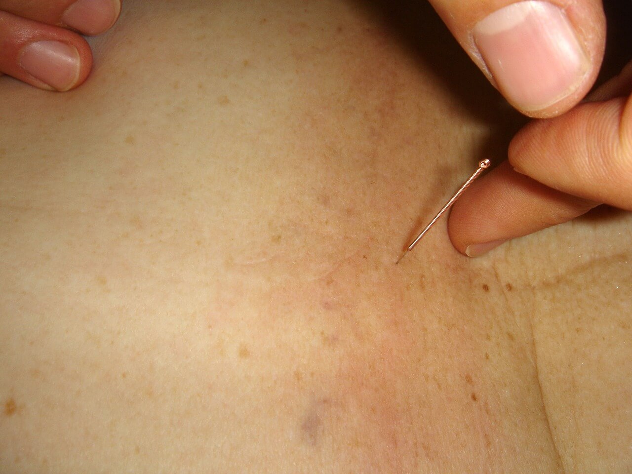 Bolesť krížov počas menštruácie. Akupunktúra