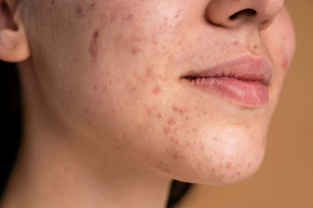 Rosacea. Akné